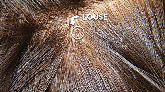 Close up image of hair with louse on its strand