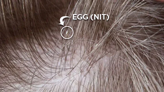 Close up of a lice egg (nit) on the shaft of somebody's hair