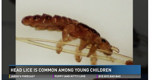 Screenshot from a news segment about how head lice is common among young children