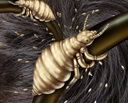 Clip art image of lice taking over somebody's hair